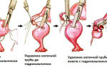 Хронический гидросальпинкс маточной трубы