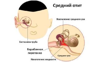 Симптомы при воспаление ушной трубы