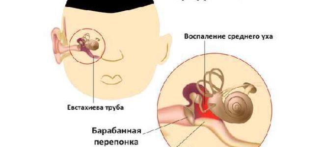 Симптомы при воспаление ушной трубы