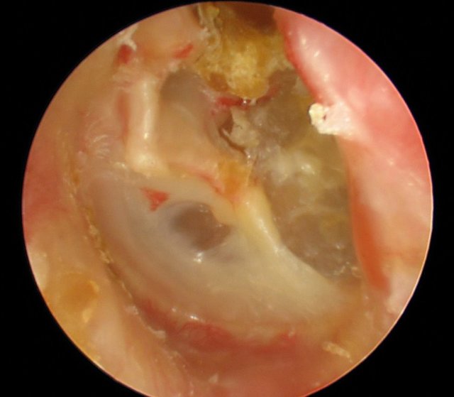 Как лечат дисфункцию слуховой трубы