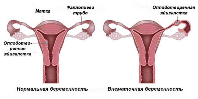 Трубная беременность операции при внематочной беременности