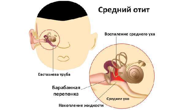 Симптомы при воспаление ушной трубы