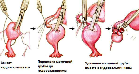 Хронический гидросальпинкс маточной трубы