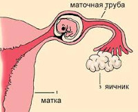 Трубная беременность операции при внематочной беременности