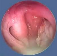 Как лечат дисфункцию слуховой трубы